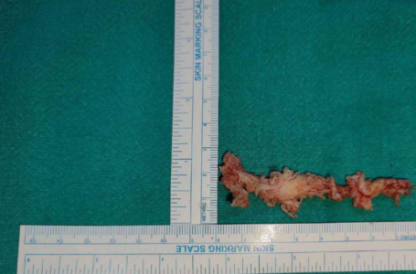 LARGEST SPINAL DISC SURGICALLY REMOVED