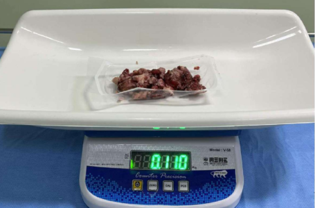 LARGEST EAR TUMOUR REMOVED