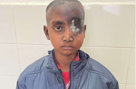 LARGEST EYE TUMOUR REMOVED