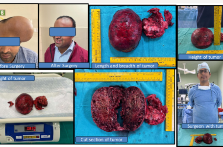 LARGEST SKULL BONE TUMOUR REMOVED