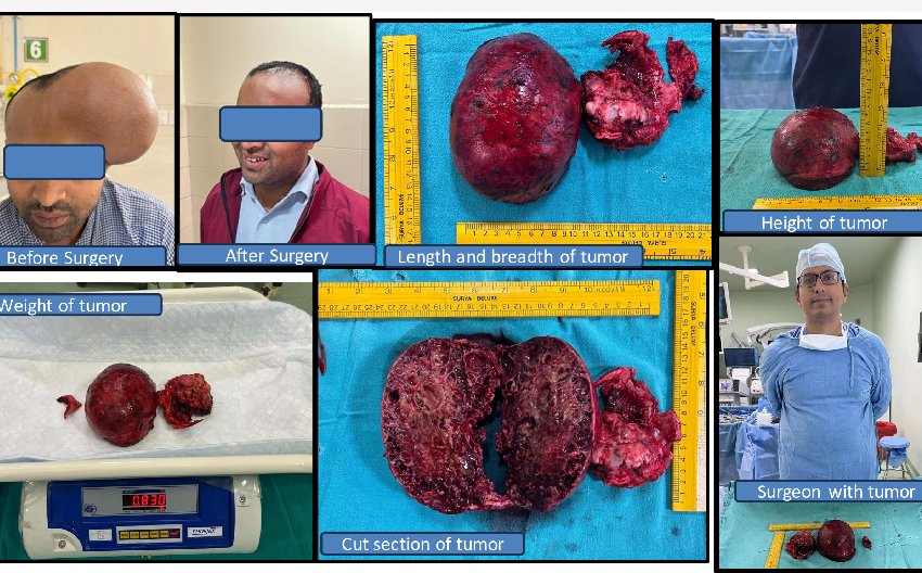  LARGEST SKULL BONE TUMOUR REMOVED
